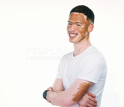 Buy stock photo Portrait shot of a handsome young man with vitiligo posing with his arms folded on a white background