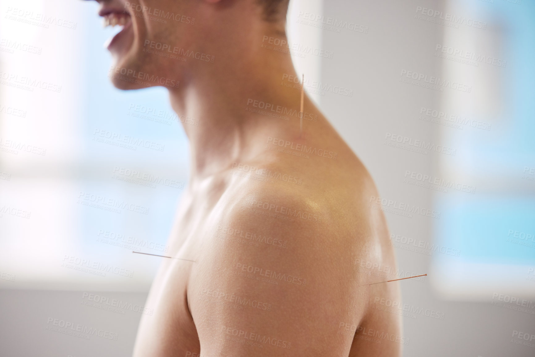 Buy stock photo Acupuncture, man and treatment of body for healthcare, healing muscle or relief from back pain. Happy, patient and physiotherapy with dry needling to relax at clinic or holistic care for injury