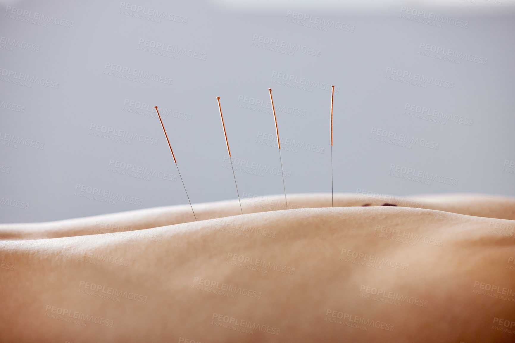 Buy stock photo Acupuncture, needles and treatment of body in healthcare, healing muscle and back pain relief. Patient, anatomy and dry needling physiotherapy to relax person at salon and holistic care for injury.