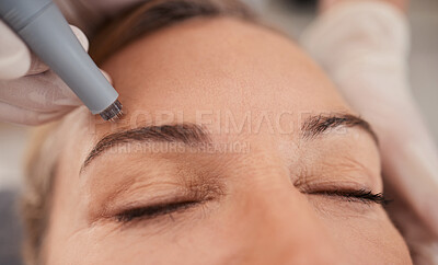 Even up skin tone with some micro needling treatments