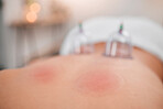 Back, cupping and therapy with a woman lying on a massage table in a spa for wellness or alternative treatment. Glass, skincare and relax with a female client resting in a beauty center for wellbeing