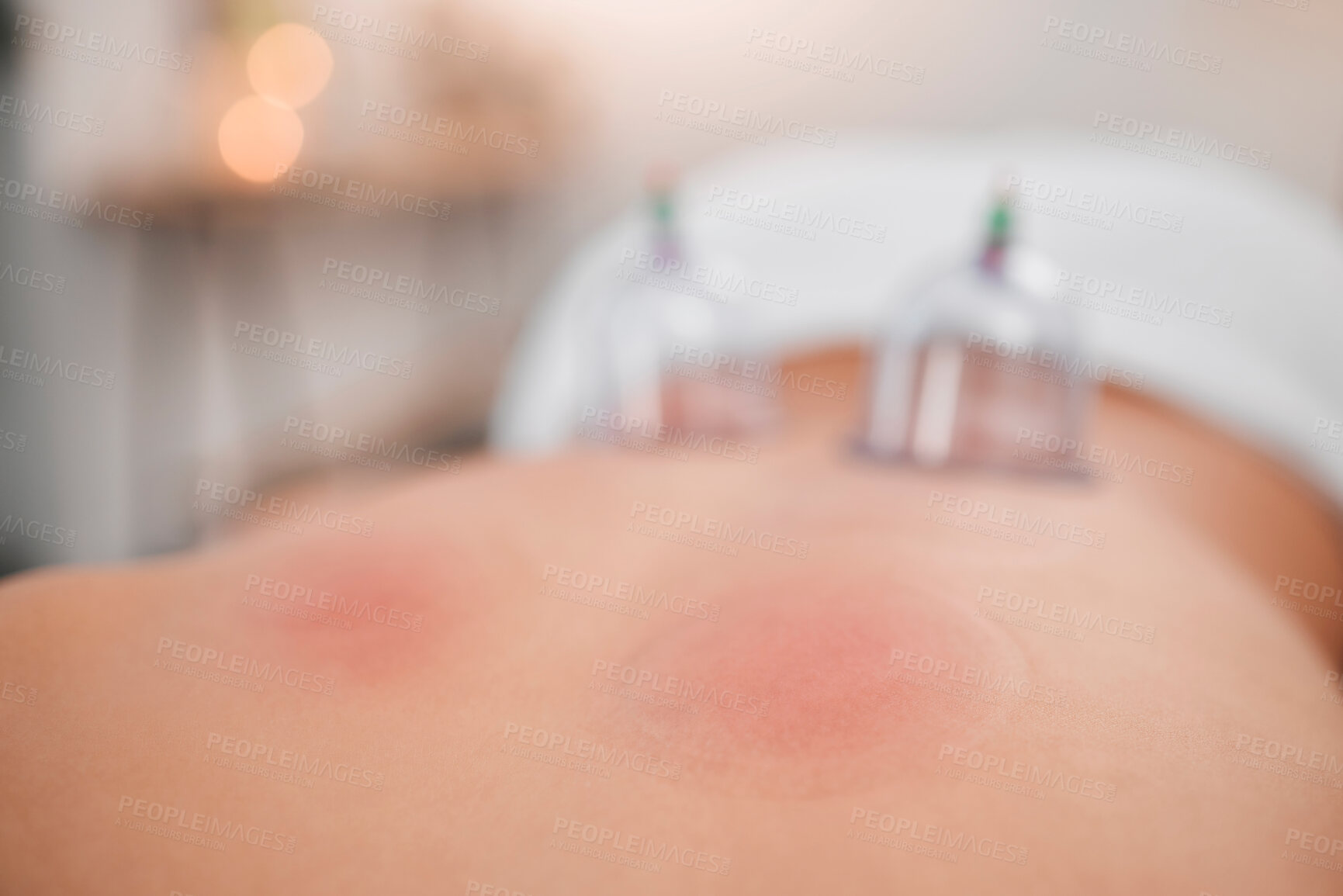 Buy stock photo Back, cupping and therapy with a woman lying on a massage table in a spa for wellness or alternative treatment. Glass, skincare and relax with a female client resting in a beauty center for wellbeing