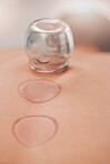 Spa, wellness and person with suction treatment on back for pain, pressure and tension relief in body. Healthcare, luxury and close up of cupping as natural medicine and traditional cure for stress