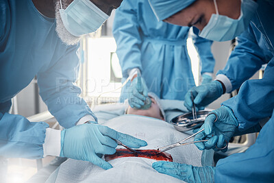 Buy stock photo Doctors, nurses or surgery hands on cut patient in hospital emergency room for stomach ulcer or burst appendix. Zoom, healthcare workers or surgical operation and steel metal equipment