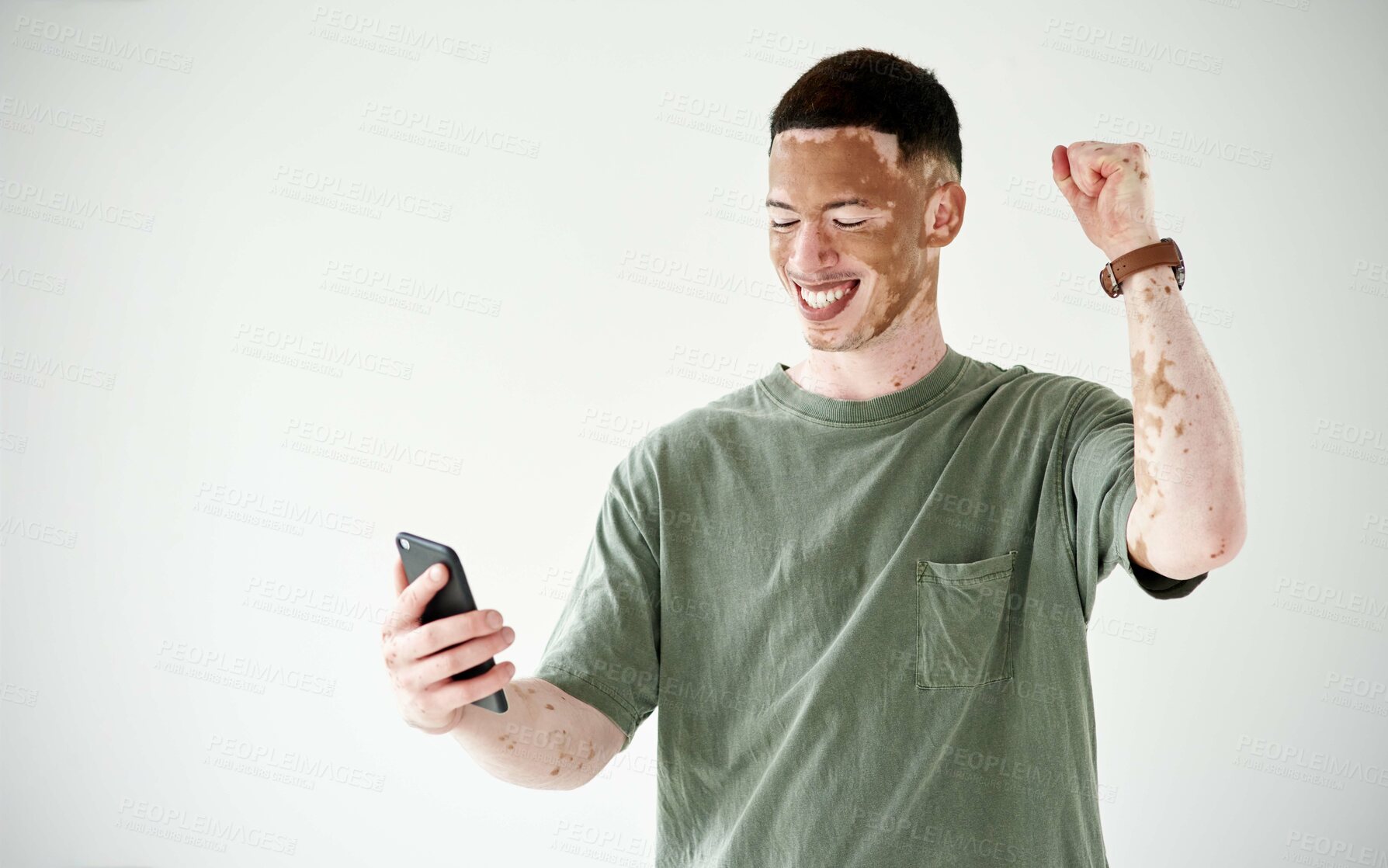 Buy stock photo Studio shot of a young man with vitiligo cheering while using a cellphone against a white background