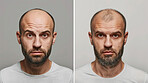 Hair loss, portrait and man with alopecia before and after for results of hair transplant, plastic surgery and prp. Bald, cosmetics and skin treatment by scalp for stress, cancer or depression in men