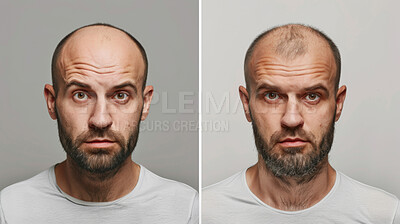Hair loss, portrait and man with alopecia before and after for results of hair transplant, plastic surgery and prp. Bald, cosmetics and skin treatment by scalp for stress, cancer or depression in men