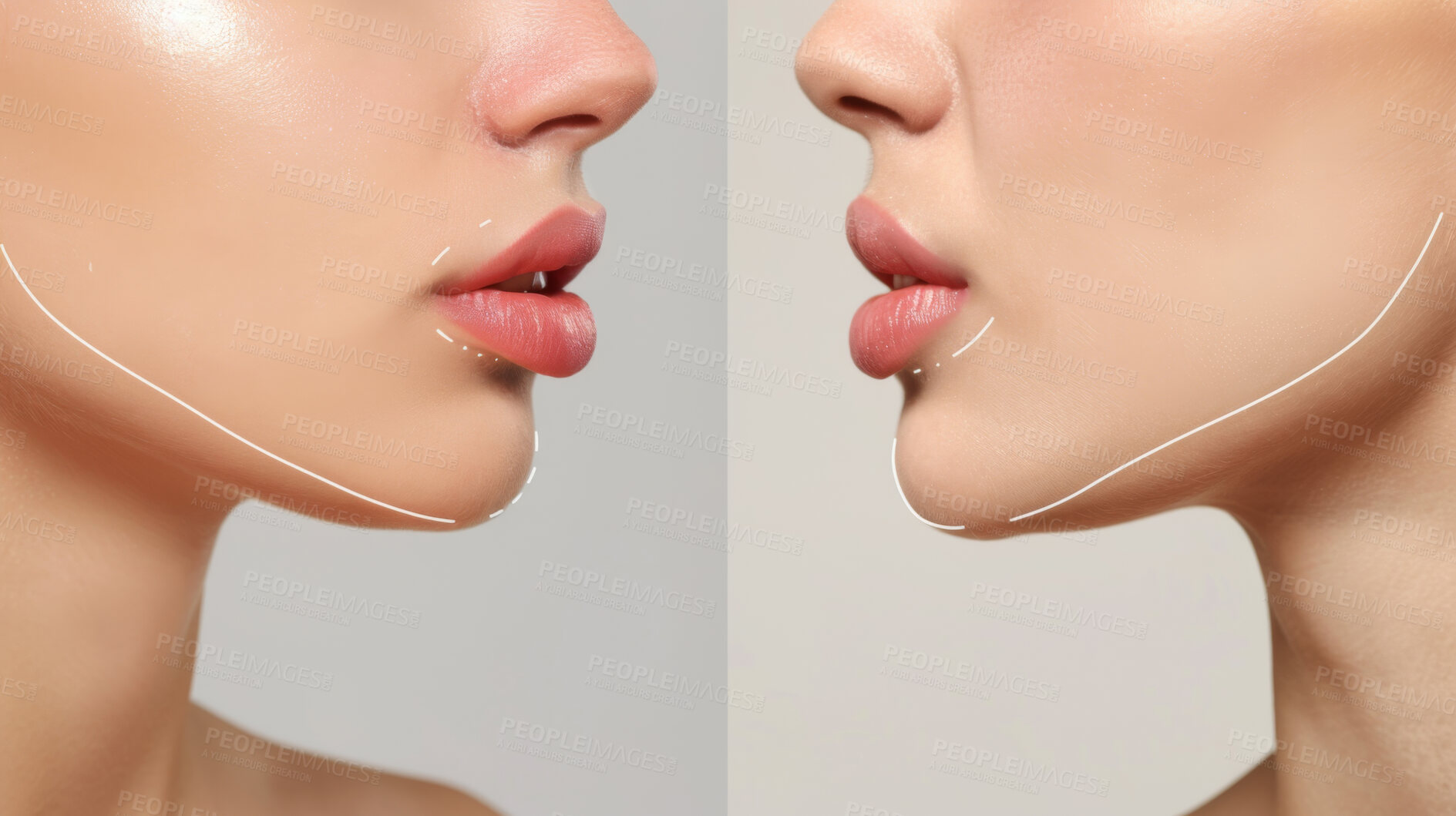 Buy stock photo Woman, before after and lips with surgery for facial with makeover in studio with lip filler injections. Care, beauty and closeup with cosmetics for fillers with augmentation from expert in clinic