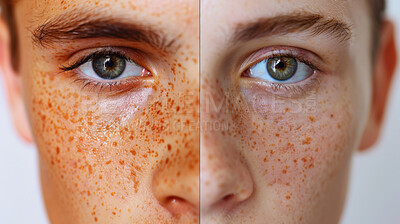 Person, eyes and portrait with freckles in skincare pigmentation or spot correction for melanin. Closeup of face with spotted skin from UV radiation, sun exposure or genetics in asymmetry for results