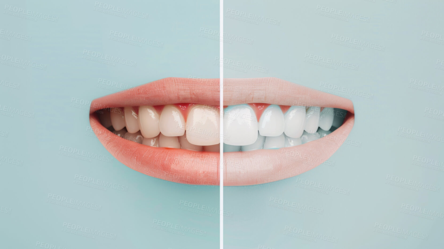 Buy stock photo Teeth whitening, mouth and veneers with before after for oral health, healthcare and enamel decay. Bleaching, toothpaste and dental implants for cosmetic treatment, hygiene and cleaning at dentist