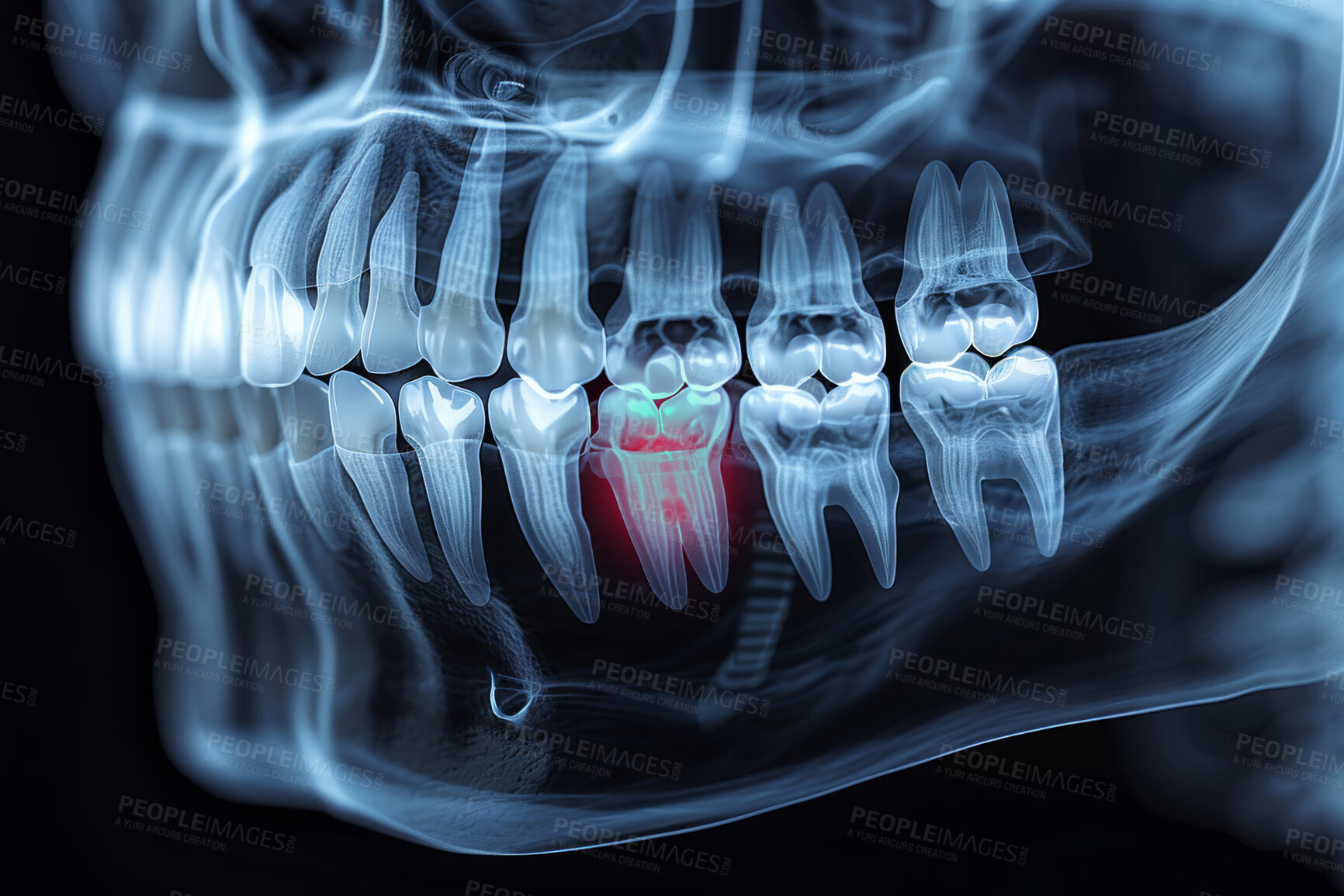 Buy stock photo Pain, xray and 3d scan of teeth in mouth for inflammation, cavity and dental examination. Anatomy, dentistry and assessment in radiology with toothache for healthcare, evaluation and root canal