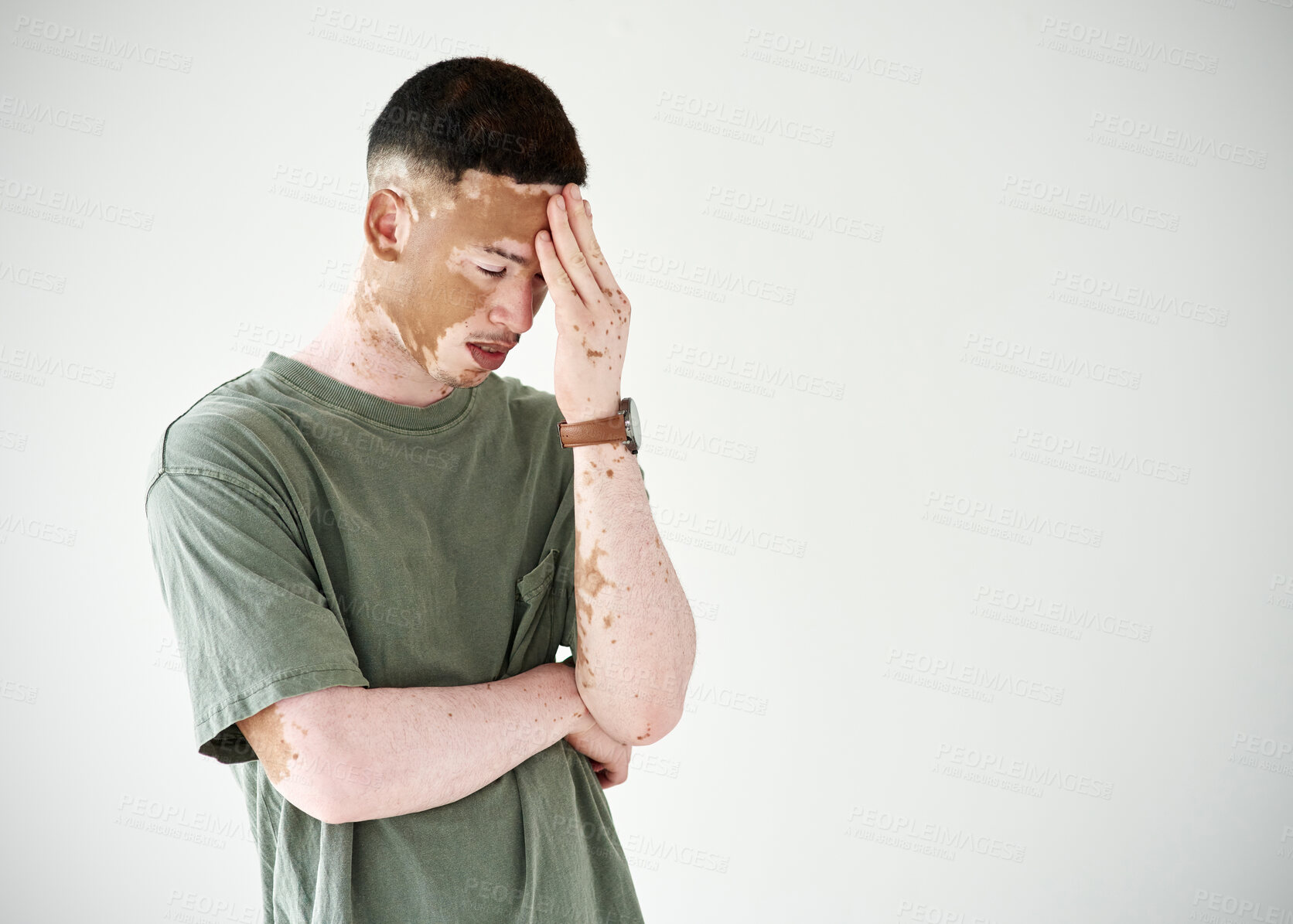 Buy stock photo Sad, anxiety and man in depression with headache and worry for vitiligo on skin in studio background. Mental health, crisis or unique dermatology condition, skincare or treatment of hyperpigmentation