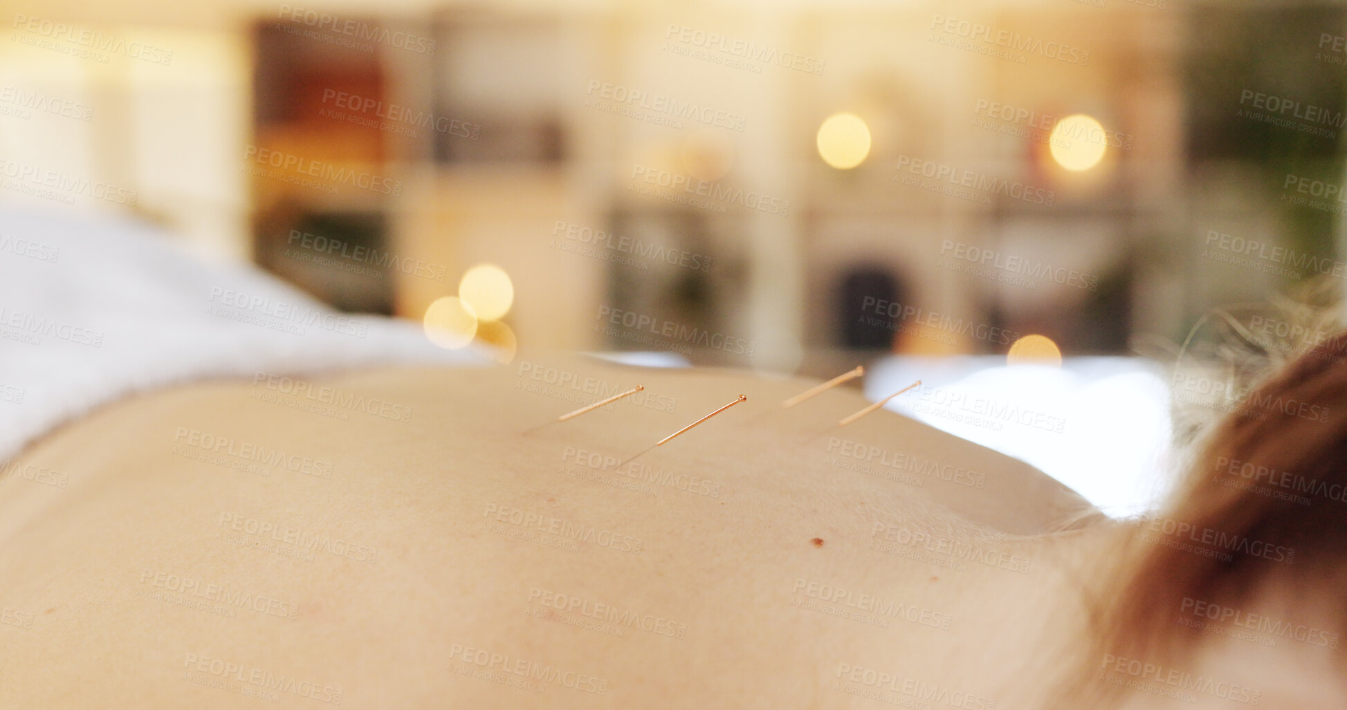 Buy stock photo Acupuncture, needles and skin for wellness in spa, alternative medicine or healing therapy. Relax, muscle and body pain in clinic for health or person, support for immune system or spine injury