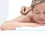 A young woman getting needles inserted into her back during an acupuncture session. A patient getting alternative therapy for medical treatment
