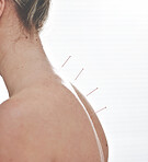 An unrecognizable woman getting needles inserted into her back during an acupuncture session. Closeup of patient getting alternative therapy for medical treatment