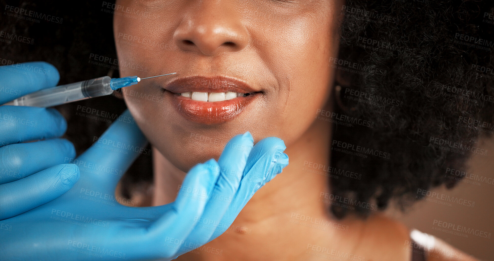 Buy stock photo Plastic surgery, lip filler and mouth of woman with gloves for skincare, facial implant and beauty. Dermatology, closeup and face of person with needle for cosmetics, anti aging and transformation