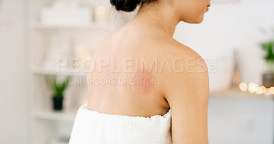 Buy stock photo Spa, back of woman and cupping therapy mark for blood circulation, muscle tension or inflammation. Bokeh, girl and suction bruise at wellness center for deep tissue massage, ancient medicine or relax