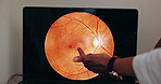 Hands, laptop screen and ophthalmologist in consultation for eye care, health and vision. Computer, closeup of image and medical optometrist or doctor in conversation, anatomy of eyeball and veins