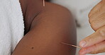 Hand, needle and acupuncture treatment for wellness, health and spiritual or chakra balance. Spa, parlour and alternative healthcare for peace, relaxation and pain or arthritis relief in skin