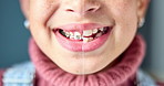 Dentistry, process and girl with braces, teeth for before and after with oral care cosmetics and smile. Closeup, kid and person with mouth for dental hygiene, treatment and results with procedure