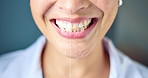 Smile, teeth and woman with before and after for whitening, dental bleaching or oral care. Healthcare, dentist and person in studio with results of dentistry for stain removal, happiness or cosmetics