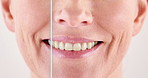 Mouth, person and happy for teeth whitening in studio background for before and after. Patient, dentistry and smile on closeup with results for dental treatment, oral care and procedure for hygiene