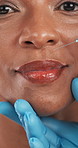 African woman, face and needle for injection for plastic surgery, lip filler and beauty. Portrait, person and surgeon for facial transformation, cosmetic implant and skincare procedure for anti aging